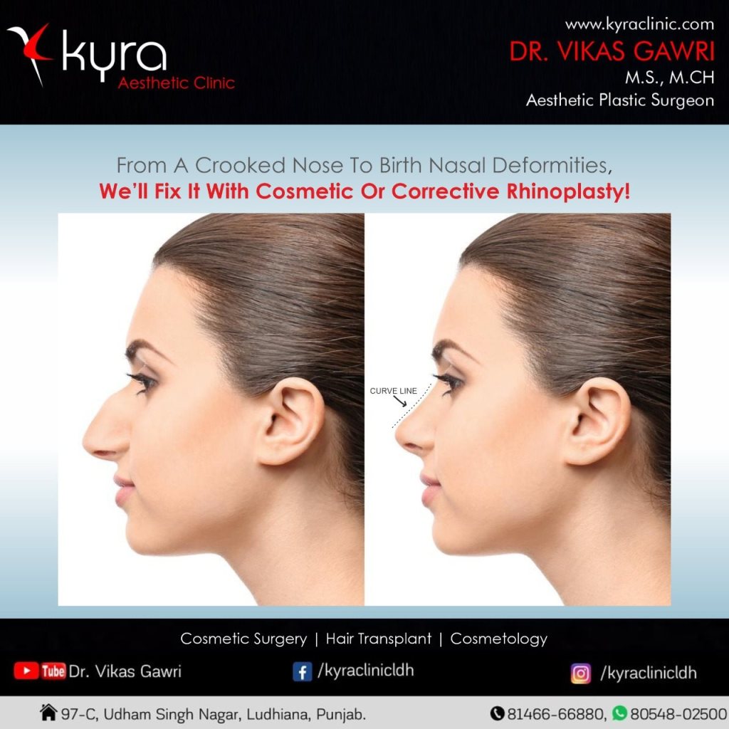 Revitalize Your Profile with Rhinoplasty in Ludhiana, Punjab: Explore Kyra Clinic’s Expertise